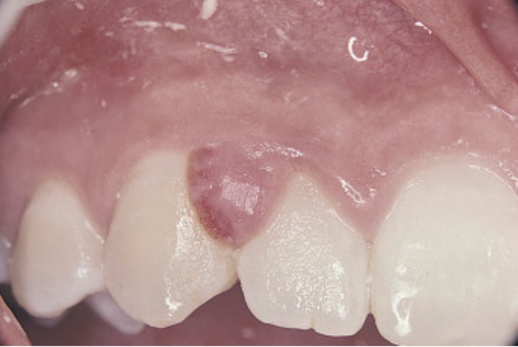 因清潔不當而造成的牙菌斑堆積 所長出的肉瘤