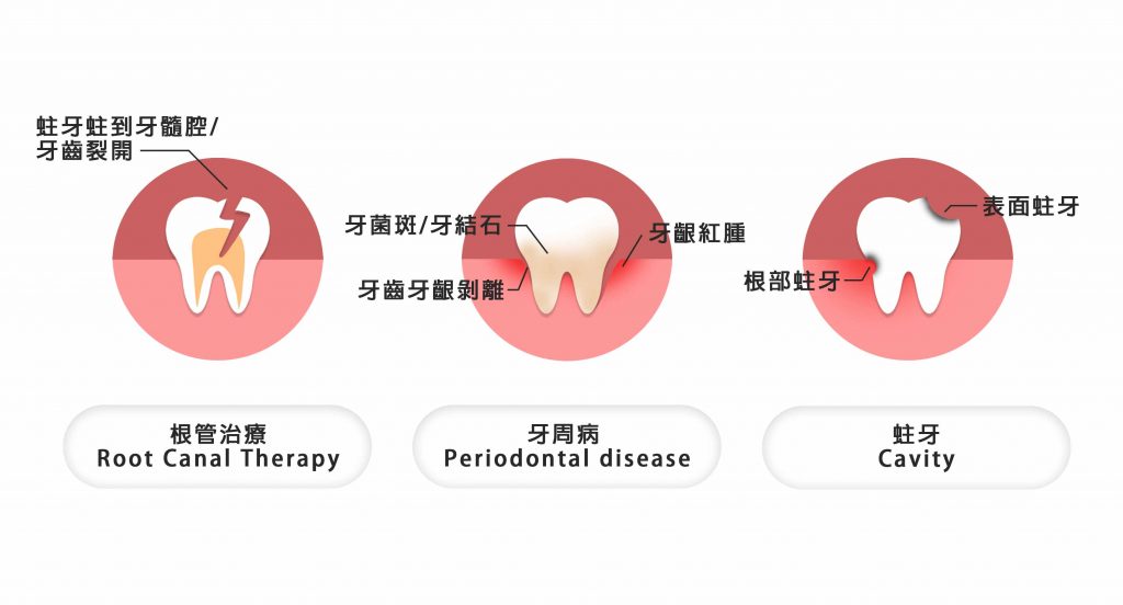 植牙前，先治療疾病牙齒