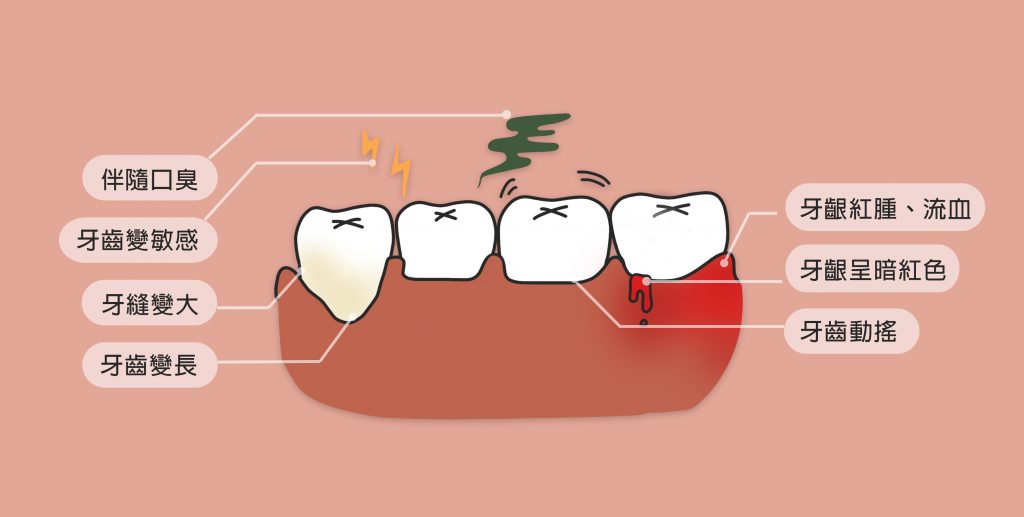 牙周病會出現的症狀