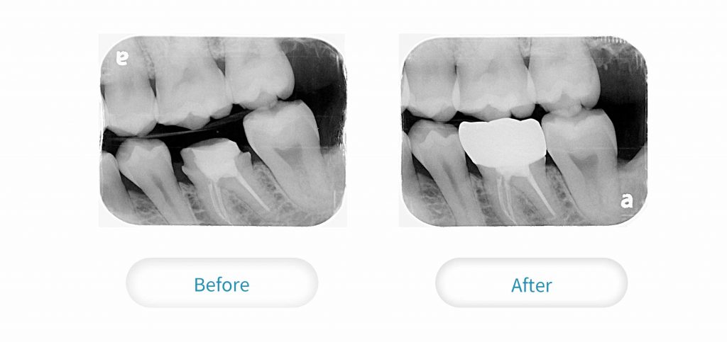 根管治療過後的牙齒，相較脆弱，需做一層牙套保護起來