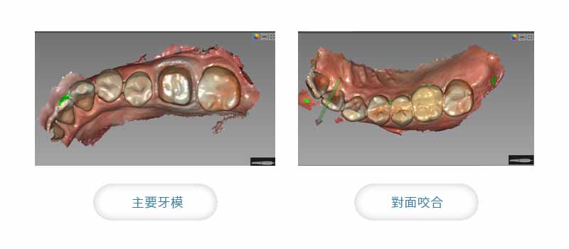 全瓷冠