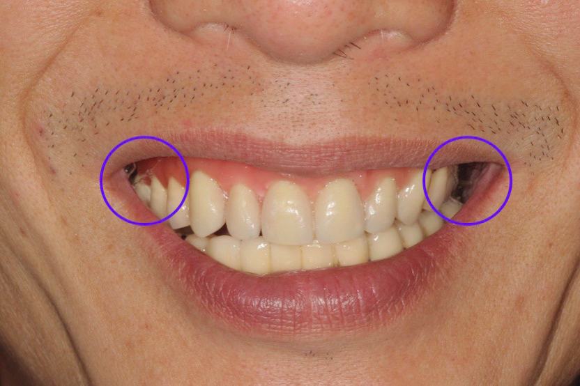 全口植牙 頰廊區為微笑時嘴角兩側與牙齒間形成的空隙 
