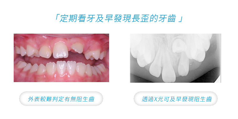 10 歲的王小妹，左上正中門牙仍未長出，X 光顯示阻生的門牙