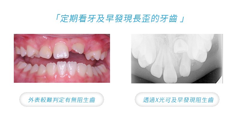 兒童矯正