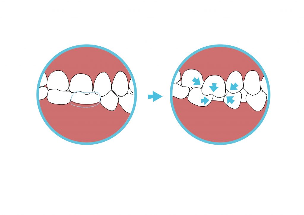 缺牙不處理，會導致鄰牙位移