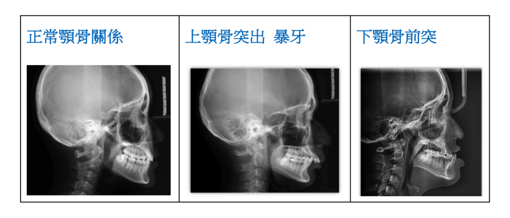 側顱X光