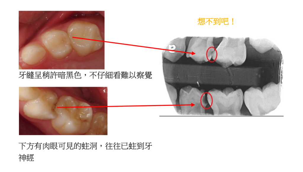 兒童X光