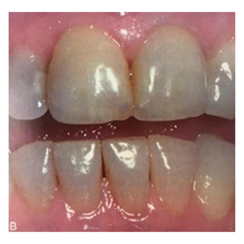 造成牙齒變色原因鈣化變質