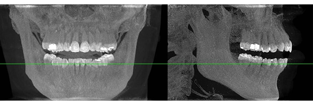 牙科X光 錐形射束電腦斷層掃描
