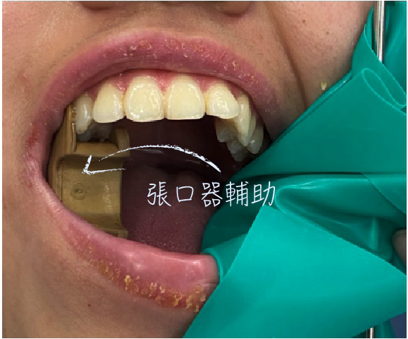 一個塑膠東西卡在口腔撐著做根管治療