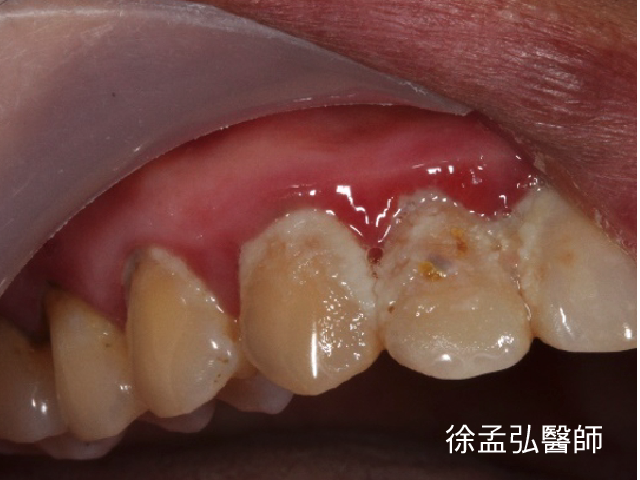 平常要用牙線清潔,每半年要洗牙,才不會造成牙結石長期堆積
