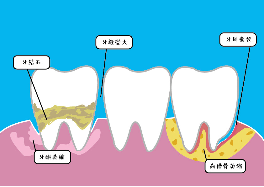 牙周病造成的牙齦問題