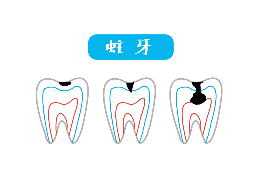 蛀牙的不同階段