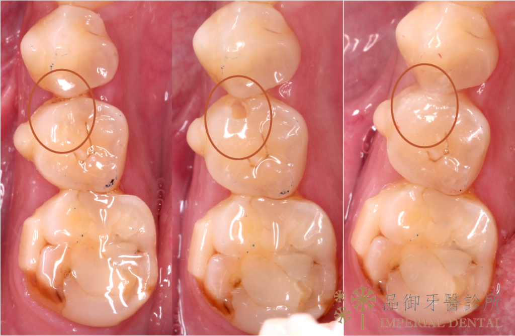 臼齒中度蛀牙補牙前後比較