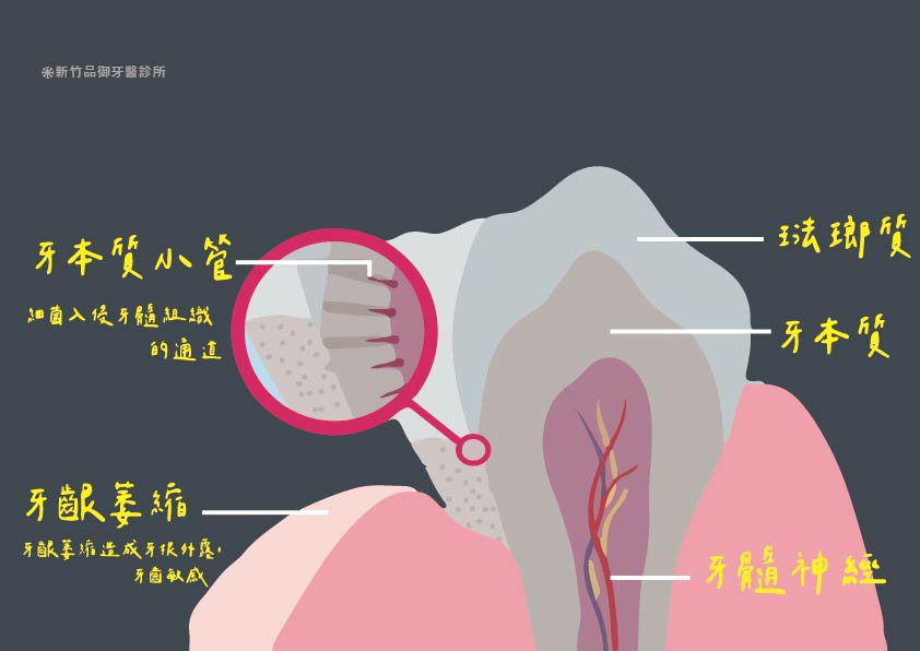 牙齦萎縮造成牙齦敏感剖面圖