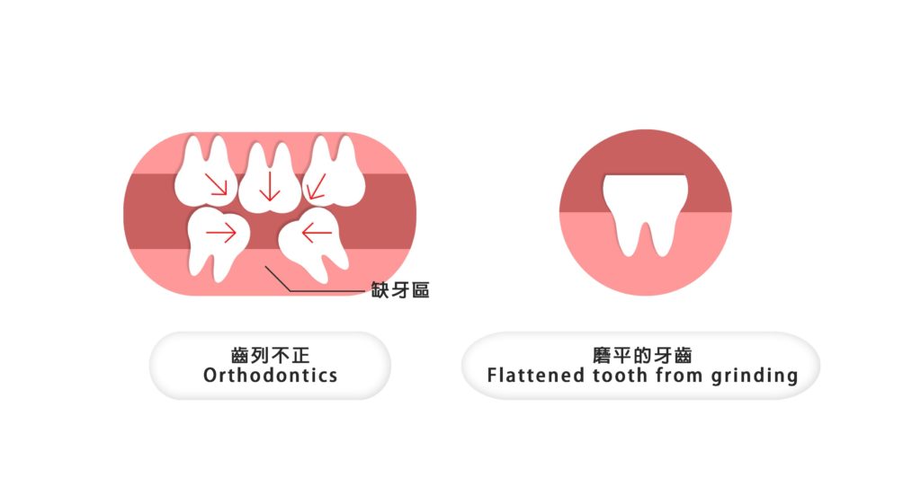 齒列不正、磨平的牙齒