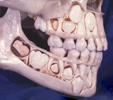 下排的恆牙牙胚，位在乳牙牙根處的偏內側。