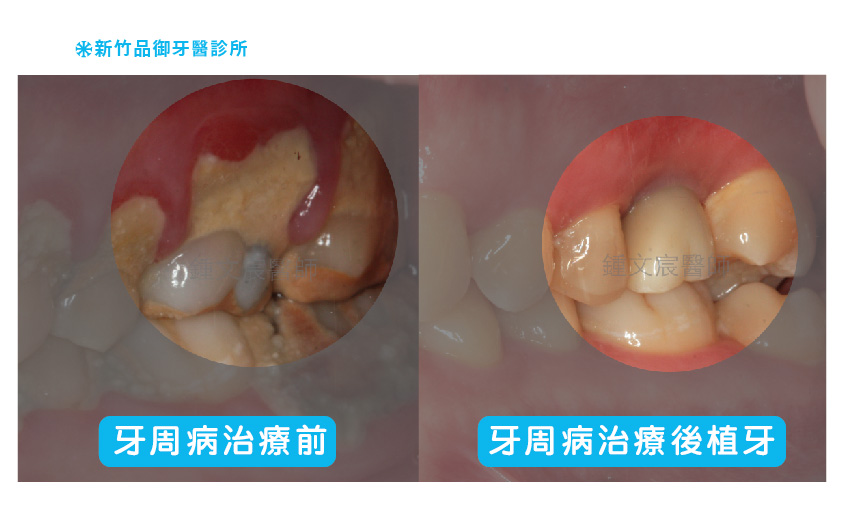 治療後牙周病植牙案例照片分享