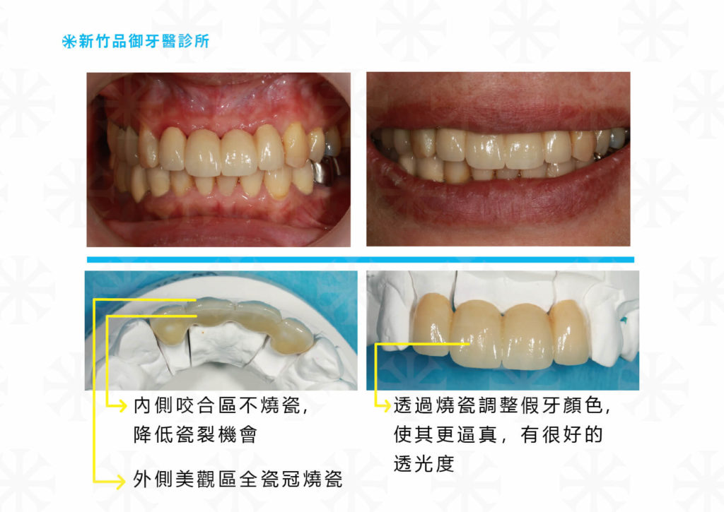 前牙假牙的全瓷冠燒瓷
