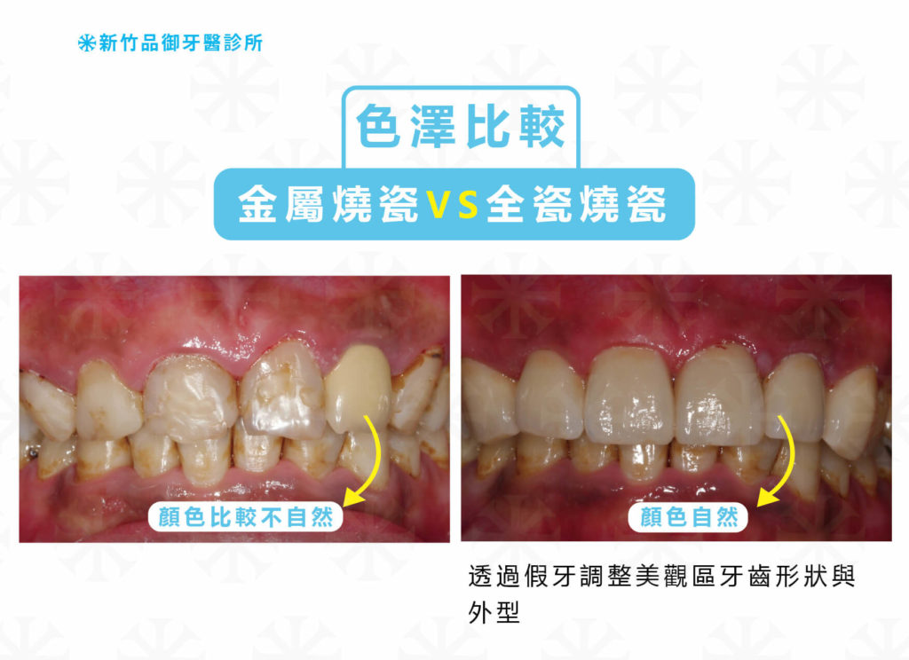 後牙全鋯冠VS後牙金屬燒瓷色澤比較照片