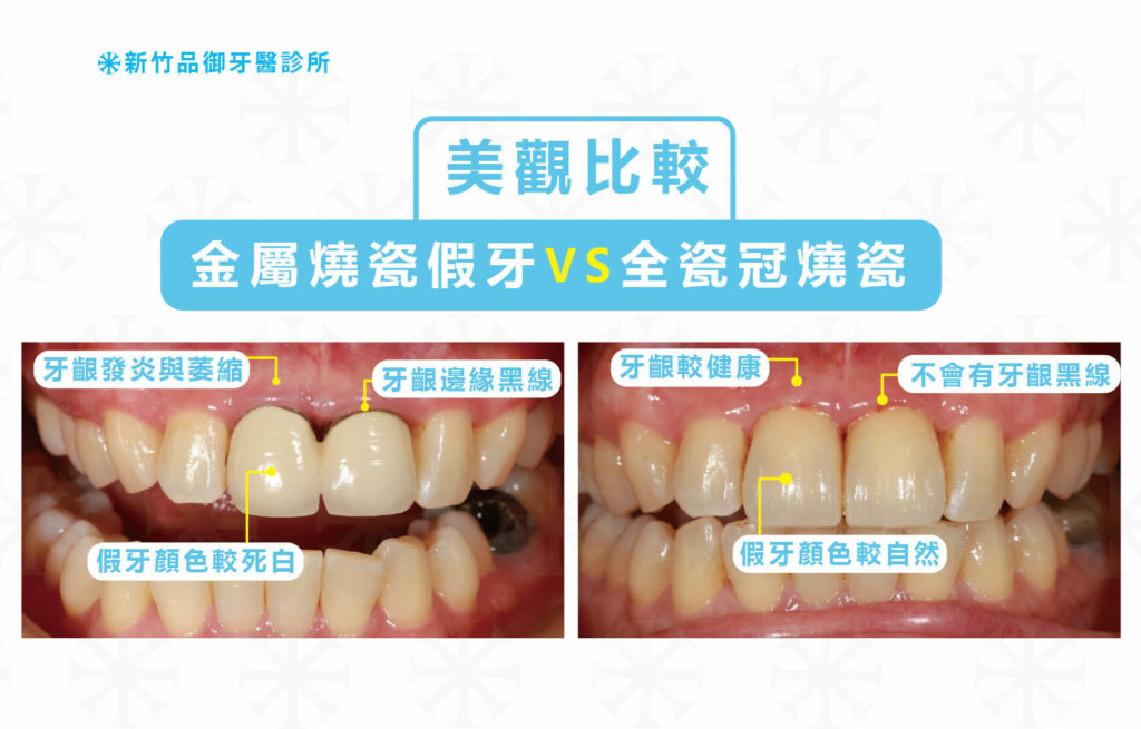 金屬假牙牙齦邊緣發黑照片