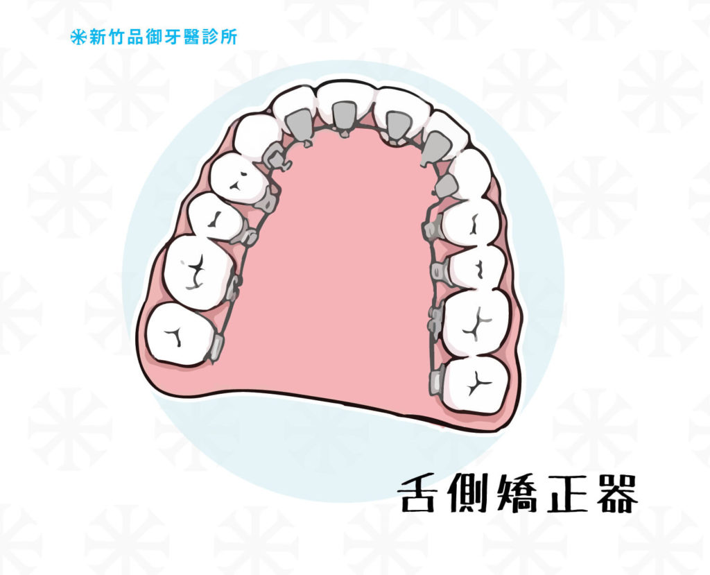 舌側矯正器