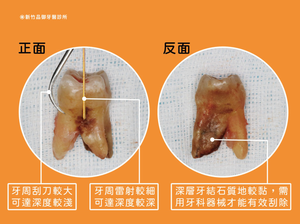 牙周刮刀與牙周雷射