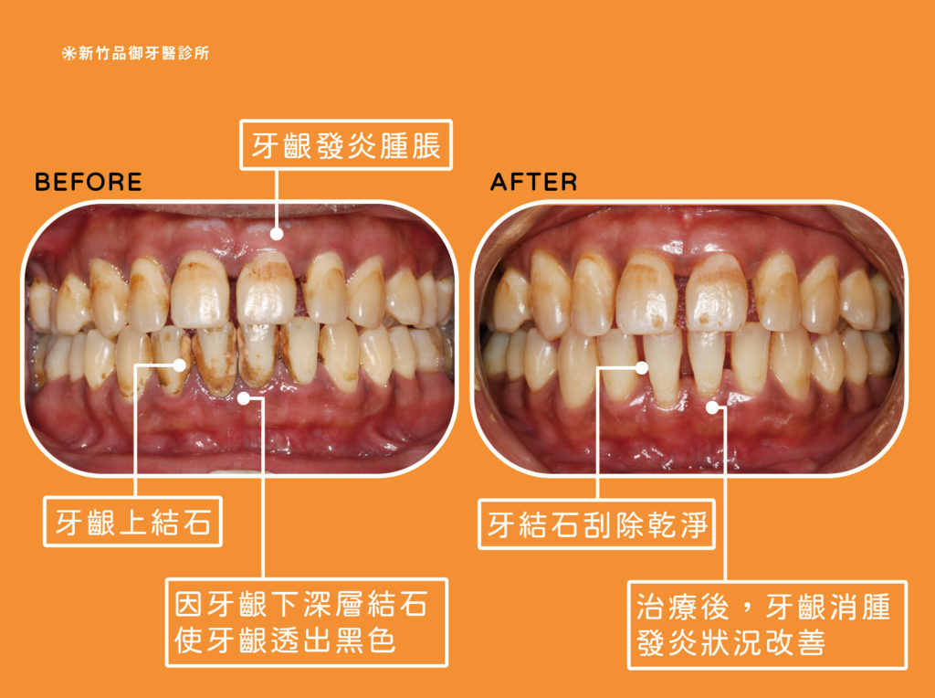 新竹全口牙周病統合治療