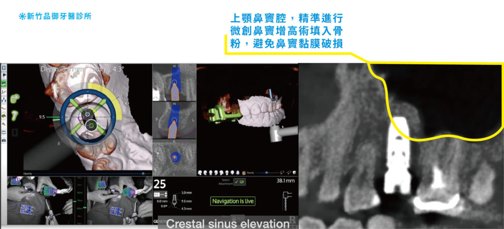 鼻竇增高術 在即時藍光導航中的影像