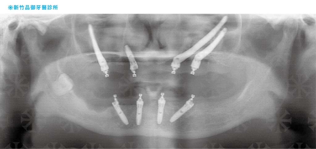 All on 4 上顎顴骨植體加下顎四根植體的Ｘ光案例