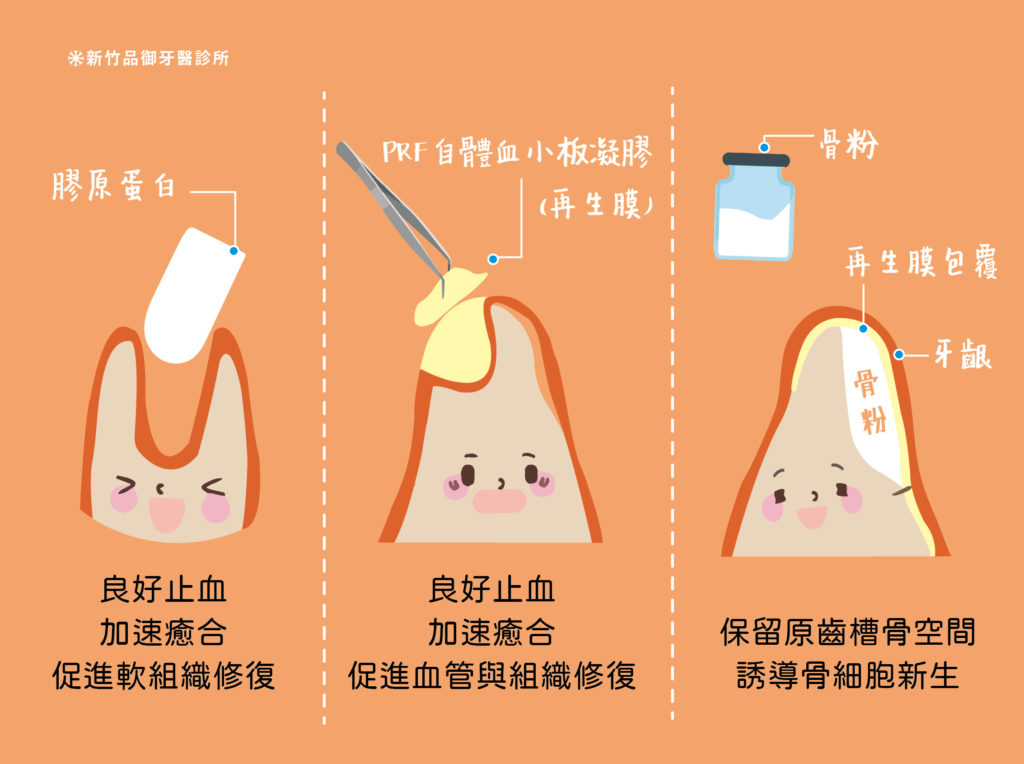 拔牙的自費填補物膠原蛋白跟再生膜