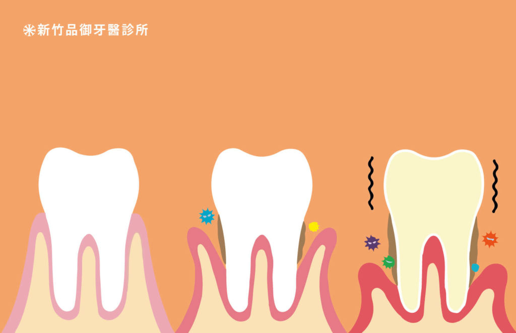牙周病造成牙齦萎縮